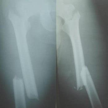 Radiographs show fractures of both femur. | Download Scientific Diagram