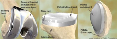 Types of Knee Replacement Options