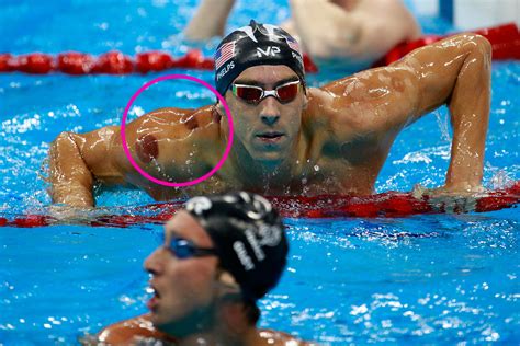 Spots on Michael Phelps - What is Cupping