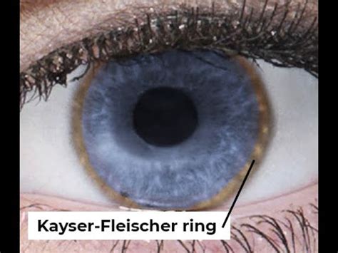 KAYSER-FLEISCHER RING IS A SIGN FOR? - Causes, Treatment, Diagnosis ...