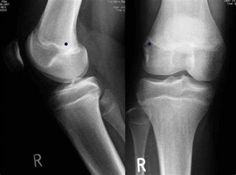 Point of anatomical insertion of MPFL ligament according to Schöttle ...