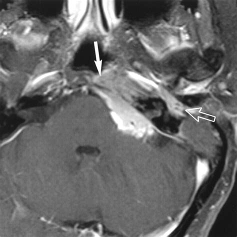 Primary Jugular Foramen Meningioma: Imaging Appearance and ...