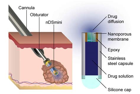 Implantable drug delivery device fights cancer while maintaining ...