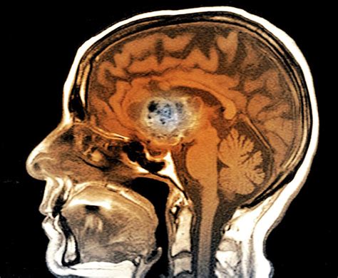 Astrocytoma Brain Cancer #2 Photograph by Zephyr/science Photo Library ...