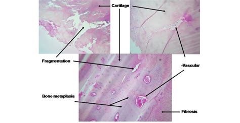 Histological analysis of explanted costal cartilage. | Download ...