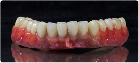 Dental Bridge Abutment