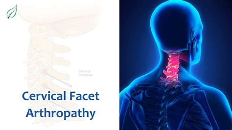 Understanding Cervical Facet Arthropathy: Causes, Symptoms, and ...