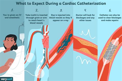 How Do They Put In A Catheter