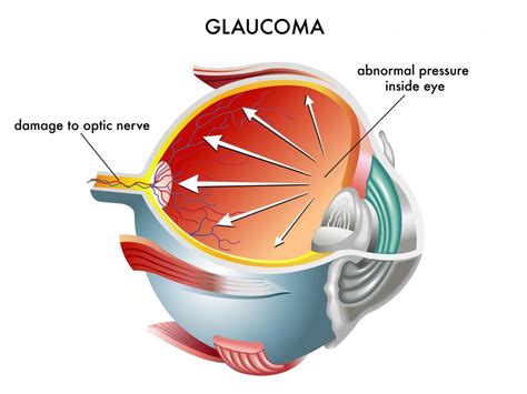 Cataract Surgery and Glaucoma - CataractEye.com