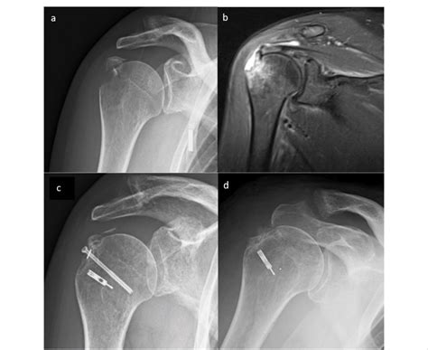 Greater Tubercle Of Humerus Fracture