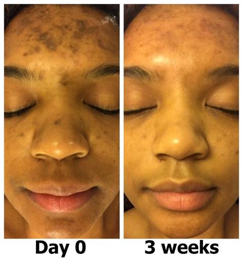 adapalene acne scars before after - Vanessa Anderson