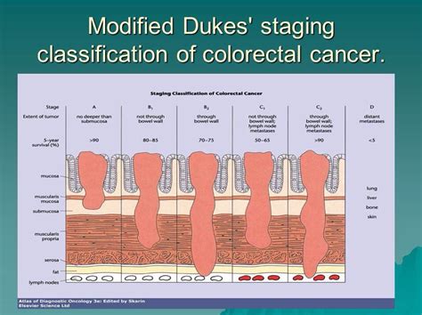 Colorectal Cancer and Polyps - Mind The Bleep