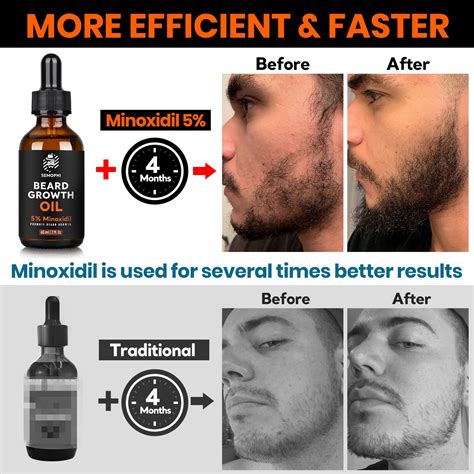 Minoxidil Before And After Beard