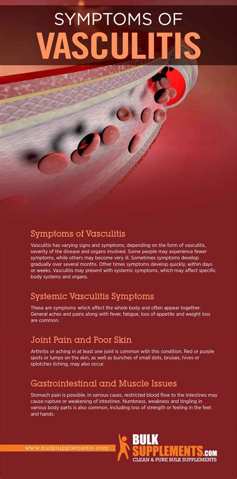 Tablo | Read 'Vasculitis: Symptoms, Causes & Treatment' by