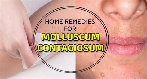 Home Remedies for Molluscum Contagiosum - Remedies Lore