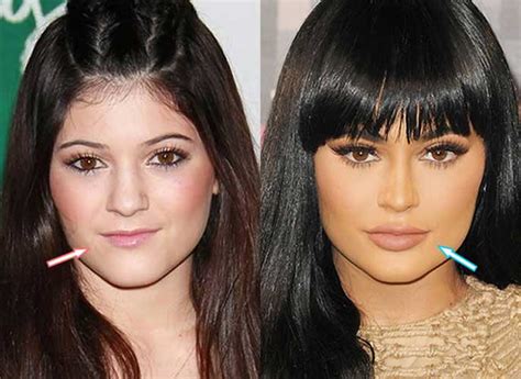 Kylie Jenner Before and after: Nose Job, Lip Injections, Breast