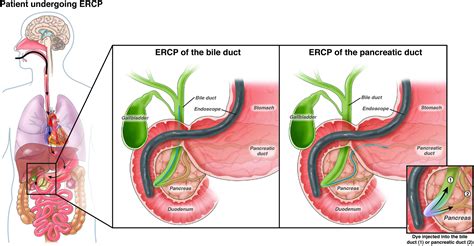 Endoscopic retrograde cholangiopancreatography (ERCP) - AGA GI Patient ...