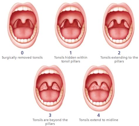 Obsessed with Obsessions: Tonsillectomy at 26 Part 1: You're crazy, why ...