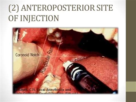 Inferior Alveolar Nerve Block Landmarks