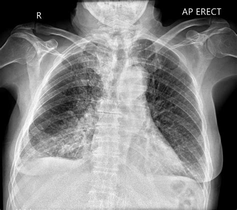 Pulmonary Edema Chest X Ray