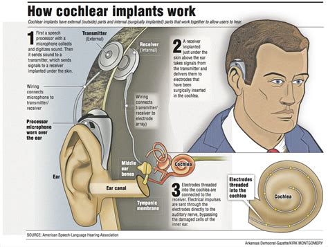 Cochlear implants give the gift of hearing, but they’re not for ...