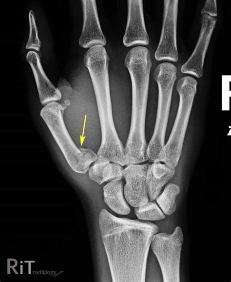 RiT radiology: Bennett's Fracture Dislocation