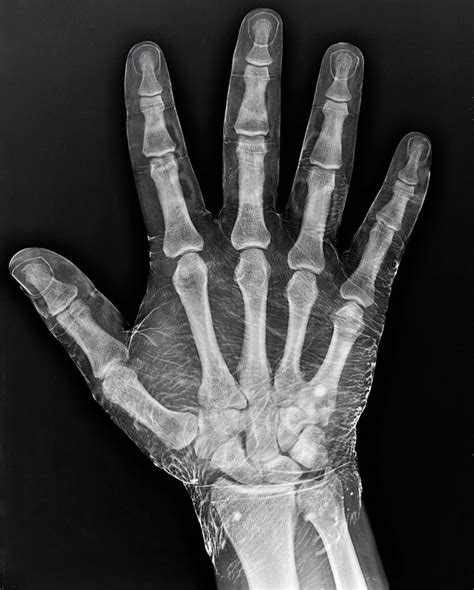 X-ray of an iodine dipped hand. | Anatomy for artists, X ray, Hand anatomy