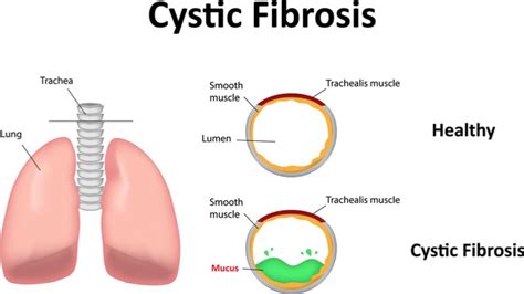 New Gene Therapy Could Treat Cystic Fibrosis With One Dose