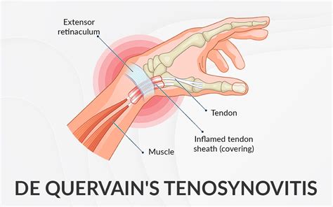 De Quervain's Tenosynovitis - Dr. Saurabh Aggarwal