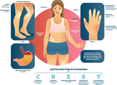 Scleroderma Causes & Treatment - ArthritisCARE