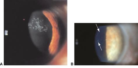 Corneal Epithelial Membrane Dystrophy - Image to u