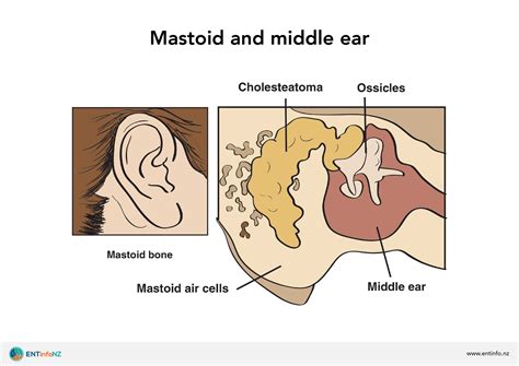 Cholesteatoma - ENT Info