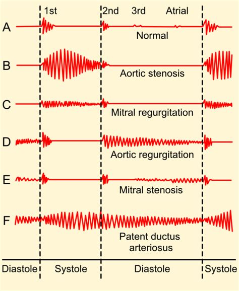 Heart Murmurs | Clinical Features | Geeky Medics