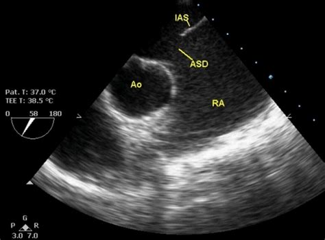 Trans esophageal echocardiogram in atrial septal defect