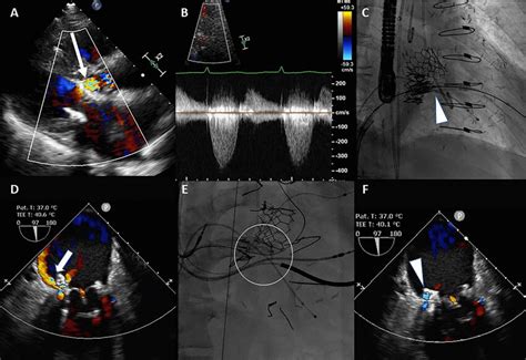 TMVR complications. A, B LVOT flow acceleration (arrow) quantified ...