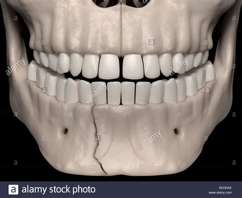 Mandibular Bone Stock Photos & Mandibular Bone Stock Images - Alamy