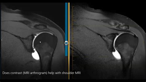 Does MRI arthrogram help see the labrum? - YouTube