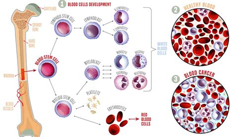 Blood & Bone Marrow Transplant, BMT | Moffitt