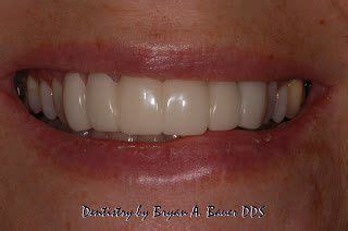 Dental flipper options and alternatives for people missing a front ...