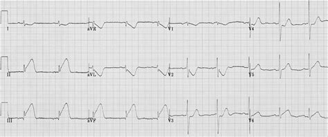 Stemi