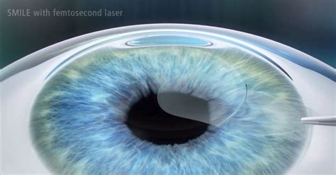 New eye surgery promises to correct myopia – Antares Optical