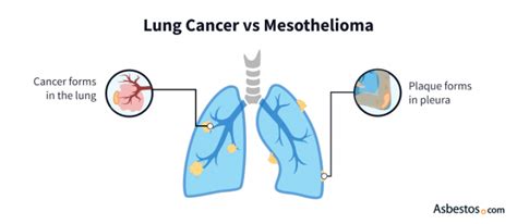 Lung Cancer Tumor Diagram