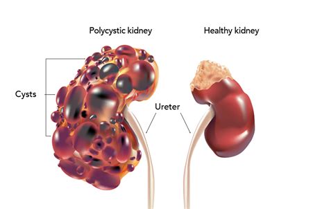 Polycystic Kidney Disease | My Doctor Online