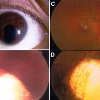 Uveal coloboma. A and B demonstrate iris coloboma (A) and choroid ...