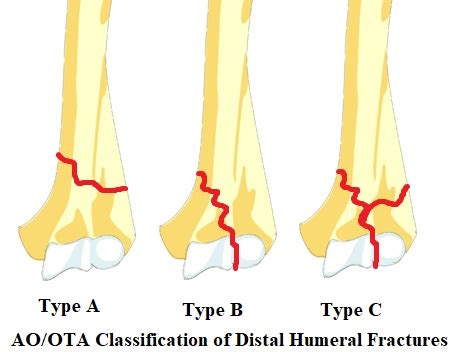 Classification AO/OTA des fractures de l'humérus distal — Wikimedica