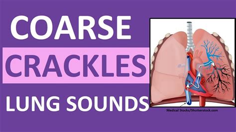 Crackles (Coarse) Lung Sounds | Crackles and Rales Breath Sounds ...