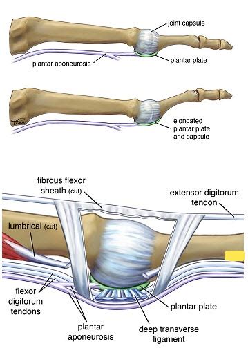 Plantar plate tear - Advanced Foot And Ankle Center Of San Diego