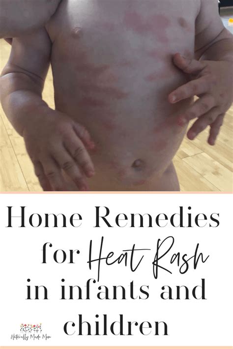 5 Best Home Remedies for Baby Heat Rash - Naturally Made Mom