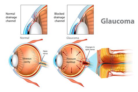 Glaucoma Treatment Springfield | Glaucoma Surgery Joplin | Missouri Eye