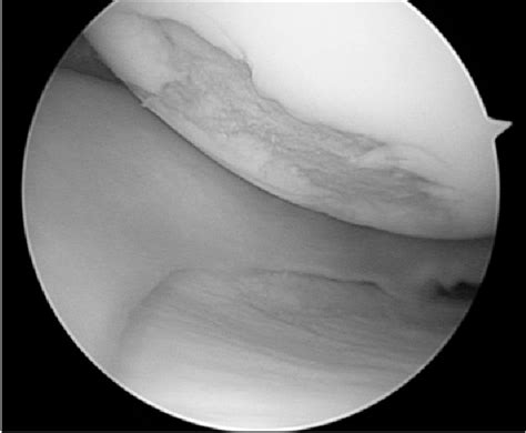 Osteochondral Lesion Medial Femoral Condyle